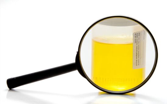 Análise de orina para diagnosticar a esquistosomiase