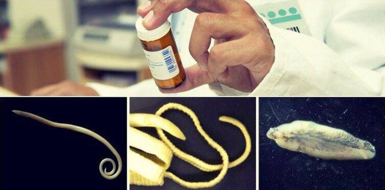 Tipos de vermes e un método médico para desfacerse deles